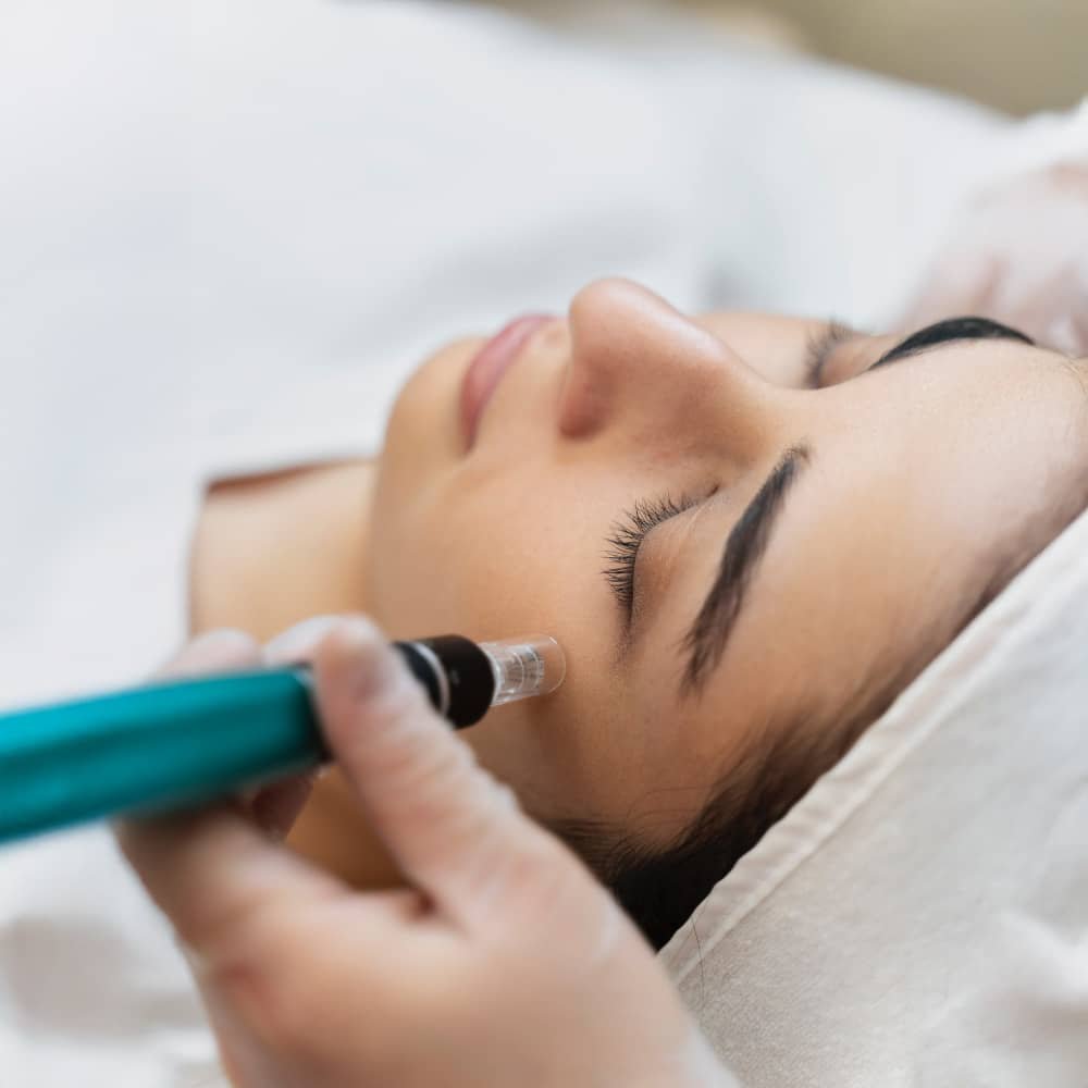 Microneedling / RF Microneedling in Santa Clara, CA