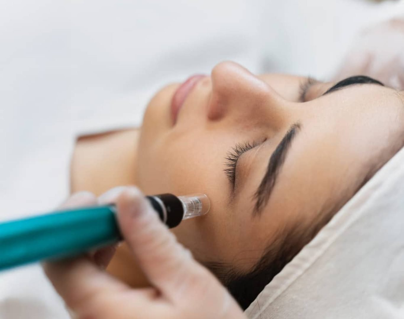microneedling-clara Microneedling / RF Microneedling in Santa Clara, CA
